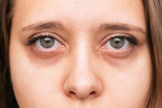 Tired, Pigmented, and Puffy Eyes