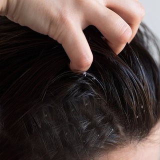 Labelled images showing dandruff on the left and seborrheic dermatitis on the right