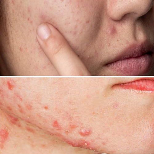 Skin Purging vs. Breakouts: How to Tell the Difference