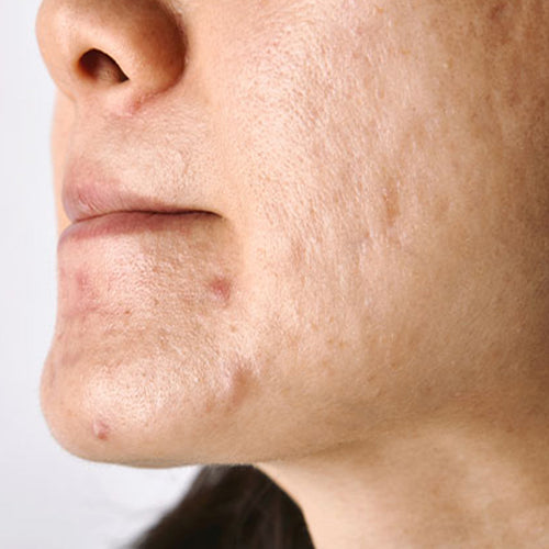What Are the Causes of Acne? 4 Reasons for Pimples on Face