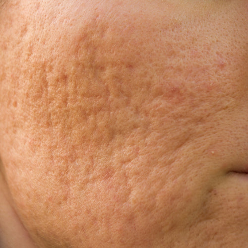 Understanding Acne Scars: Causes, Types, and Effective Treatments
