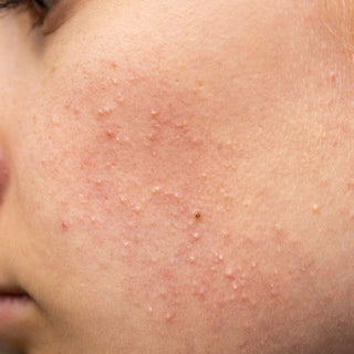 Closed comedones treatment