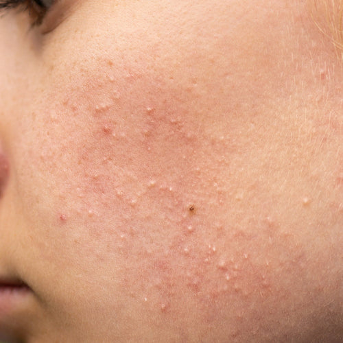 Closed Comedones? Here’s How to Unclog Pores and Treat Them the Right Way