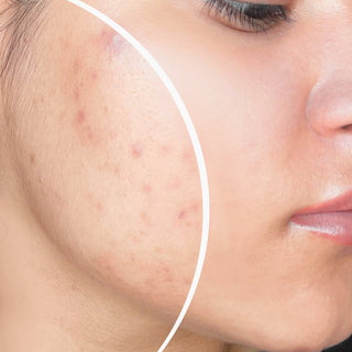 What is Acne?