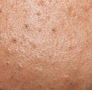 Non-Inflammatory Acne (Blackheads, Whiteheads, Comedones)