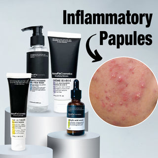 Treat Inflammatory Acne