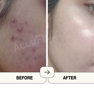 Before and after of using Salicylic acid cleanser - AccuFix Cosmetics
