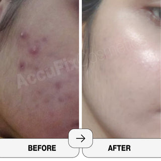 Pimple on Face? Chin Acne & Forehead Breakouts: The Basics Explained