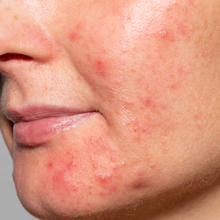 Acne: Causes, Types, Prevention & Treatments