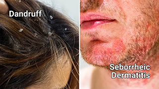 Labelled images showing dandruff on the left and seborrheic dermatitis on the right