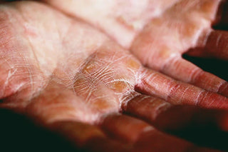 Eczema And Dermatitis: Causes And Treatment