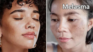 Melasma: The Complete Guide To Its Causes & Treatment