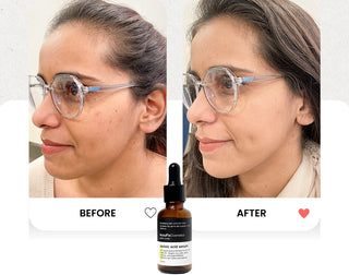 azelaic Acid before after