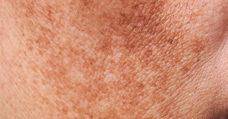 How to Treat Pigmentation Safely — What Actually Works