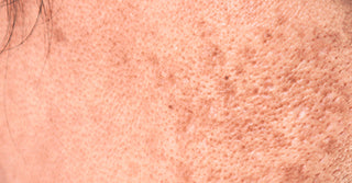 skin pigmentation