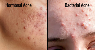 Hormonal Acne vs. Bacterial Acne: Understanding the Triggers