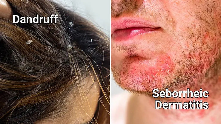Seborrheic Dermatitis Dermatitis | Types Of Dermatitis