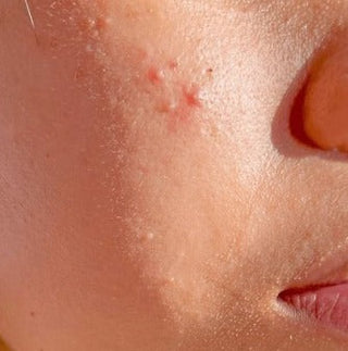Hormonal Acne