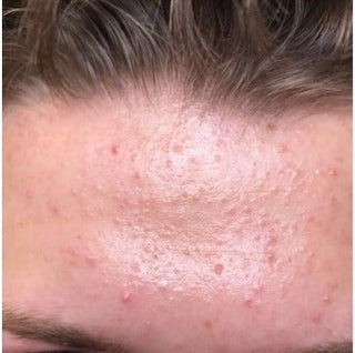 Fungal Acne