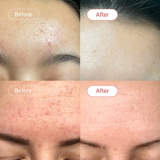 Salicylic Azelaic Acne & Marks Duo
