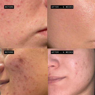 Encapsulated Salicylic Acid Bundle