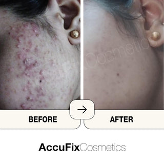 AccuFix Acne Starter Bundle Review