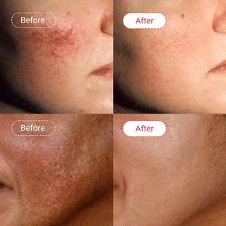 Azelaic acid serum Beore & After