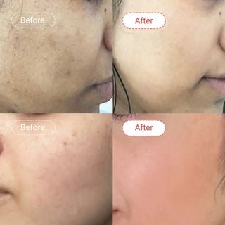 Kojic acid + Glutathione cream Before or After