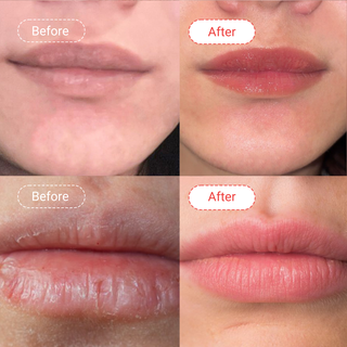 Lip Pigmentation Bundle