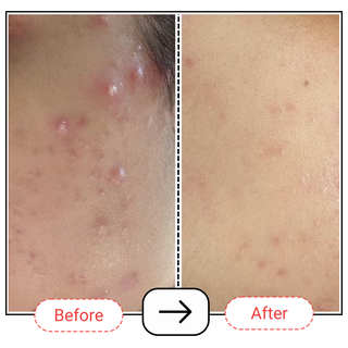 Niacinamide Serum | Niacin Serum