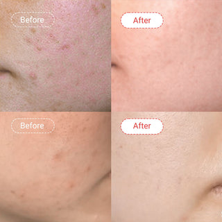 Salicylic Acid Cleanser Before & After