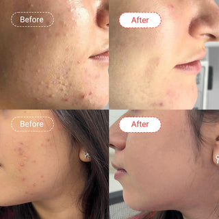 Salicylic acid cream |  Before & After | AccuFix Cosmetics