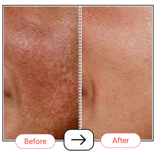 Retin-oil Serum 0.2%-1.0% | Best Retinol Serum