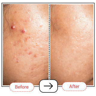 Encapsulated Salicylic Acid & Niacinamide Serum