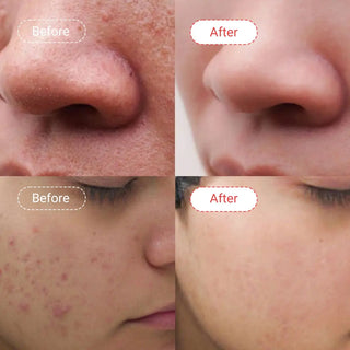 Before/after results using Salicylic Acid Gel Face Wash for improved skin clarity | AccuFix Cosmetics