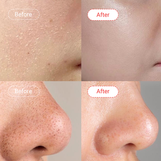 Blackheads & Whiteheads Fix (Dry Skin)