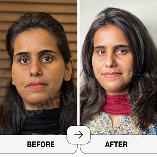glycolic acid before and after