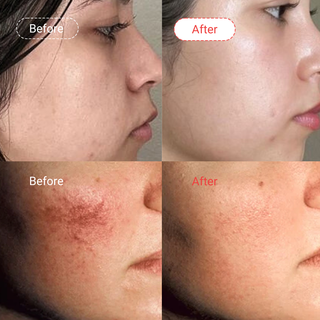Rosacea Treatment Bundle